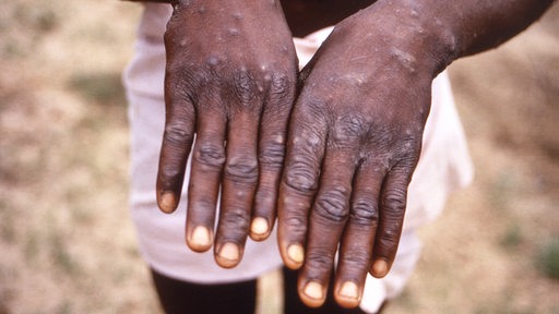 Ein Mann aus Kongo zeigt seine mit Affenpocken (Mpox) übersäten Hände.